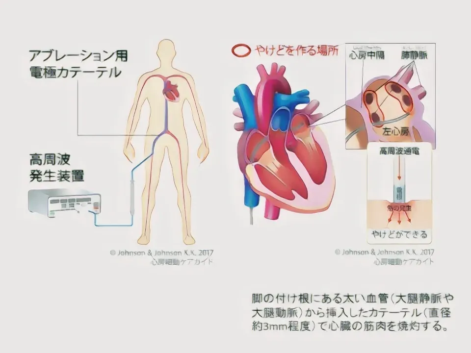 カテーテルアブレーション手術