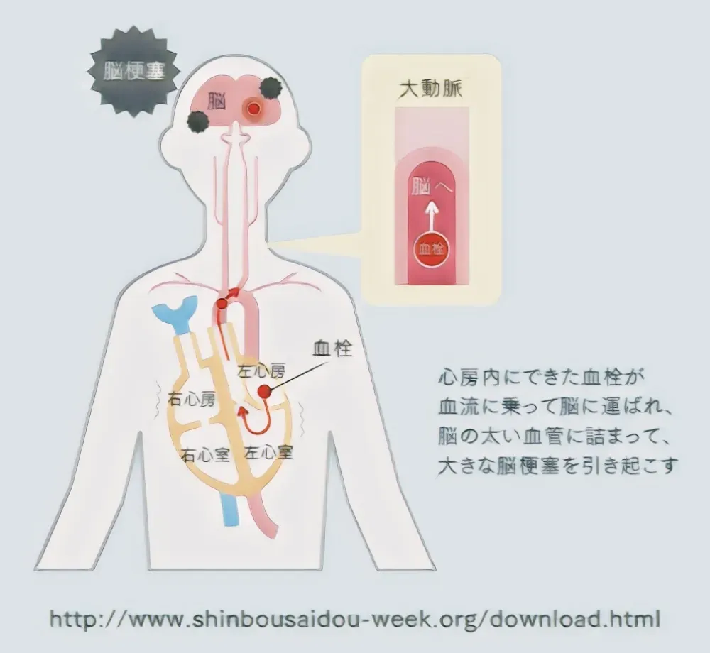 心房細動の症状