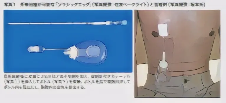 自然気胸の治療法